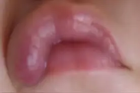 口腔血管瘤是“伪装者”，如果有这些表现，我们就要注意了图片