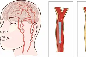 脑梗来临并非“静悄悄”，提醒：身体出现4种异常，或是脑梗前兆图片