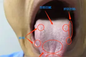 舌诊分析：舌头发尖，舌苔白，是肝气不舒吗？如何调理图片