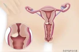 接触后流血是宫颈癌吗？男女出现反复感染！怎么办？图片