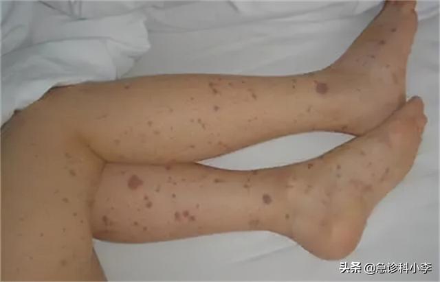 手上长了很多小红点