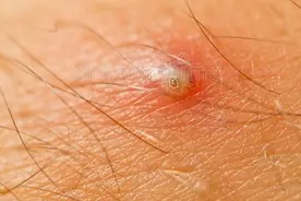 皮肤科医生和聊聊：皮肤疖是什么问题？需要如何防治？图片