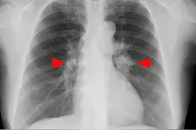 肝癌淋巴结转移恐怖吗？这4点一定要记住图片