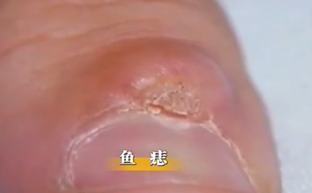 起鸡皮疙瘩的坏处