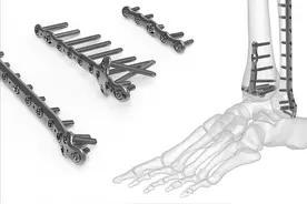 骨折手术后，多长时间能取钢板，留着不取可以吗?图片