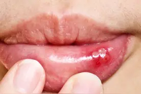 口舌生疮、牙龈肿痛，吃什么药好？快速消炎止痛，可以这样做！图片