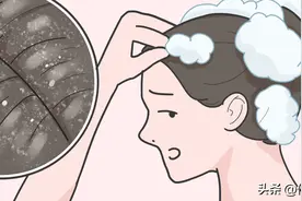急急急！头皮屑很多，究竟怎么办？皮肤科医生告诉你这些干货图片