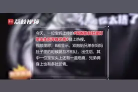 产科医生辟谣双胞胎肚内打架：都不在一个“房间”图片