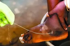 这4种食物容易有“寄生虫”，开水可能烫不死，吃之前要小心图片