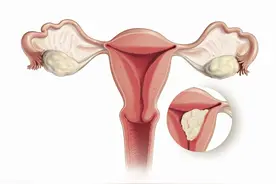女性阴挺是怎么回事？对身体健康有影响吗？需要治疗吗？图片
