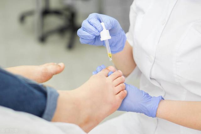 脚趾缝痒脱皮抓破后出水鳞屑角化型