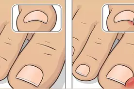 有一种痛，叫指（趾）甲长到肉里图片