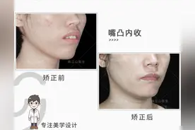 严重骨性前凸后缩+重度露龈笑+深覆盖8mm？美学正畸来爆改！图片