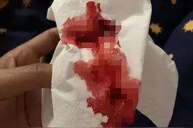 年轻女子洗澡时突然咳血，怀疑肺癌，男朋友无意间的一句话救了她图片