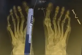 女子爱穿高跟鞋致双脚外翻严重变形，医生：此病发展非常快，严重的话会畸形，影响行走图片