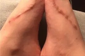拇外翻手术伤口竟然这么大 还有钢钉图片