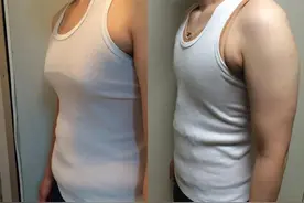 48岁，终于把胸“噶”了！到北京做“微创手术”朋友说换了个人。图片