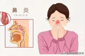 小鼻子，大学问！孩子没感冒，为什么总鼻塞、流涕、打喷嚏？图片