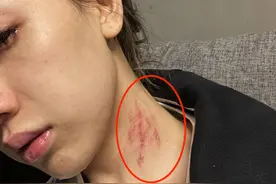 歌手Free C晒家暴照片，自曝被感染HPV及经历，美女沦为玩物太可怜图片