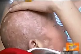 2009年，江西夫妇生下怪异婴儿，全身长满“树皮”医生被吓出冷汗图片