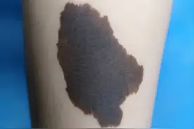 自查！孩子身上的胎记和痣，如果长成这样，赶紧看医生！图片