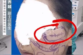 面部吸脂术全流程实录#面部提升图片