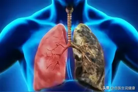 提醒：身体若出现3种异常，可能是肺癌的信号，别不当回事图片