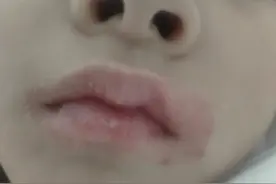 口角炎反反复复怎么办？图片