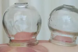 拔火罐吸出来的瘀血，是体内的毒素吗？老中医告诉你答案图片