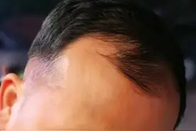 16000字讲述植发真实感受图片