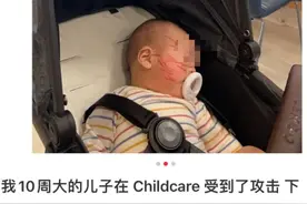 墨尔本华人宝宝在托儿所被严重抓伤满脸伤痕！商家爆歧视言论图片