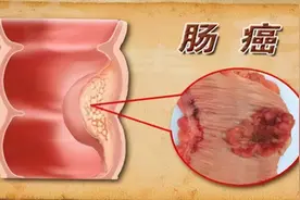 渭南肛肠专科医院：一天三次大便和三天一次大便，哪个才是大肠癌？哪些异常要注意？图片