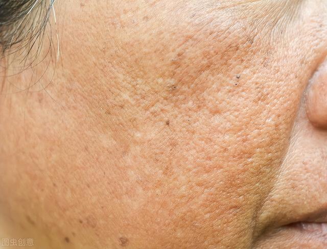 为什么脸上会长鸡皮肤怎么办