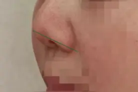 那些做了硅胶后鼻挛缩、鼻翼缘退缩的人，现在都怎么样了？图片