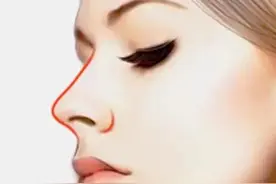 肋骨隆鼻加筋膜和不加筋膜的区别可不只是体现在效果上图片