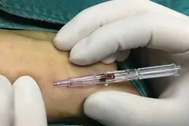 桡动脉穿刺不是一件「小事」，操作流程与压力监测请细看专家共识图片