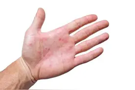 艾滋病的皮肤症状原来是这些，不看不知道。图片
