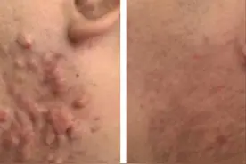 华中首台浅层X射线系统落地三年，为千余瘢痕疙瘩患者“祛疤焕肤”图片