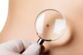 脖子和腋下长出的小肉粒，不痛也不痒，是啥东西？该怎么处理？图片