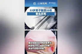 33岁男子酗酒20年致股骨头坏死：13岁开始喝酒，每天饮半斤以上图片