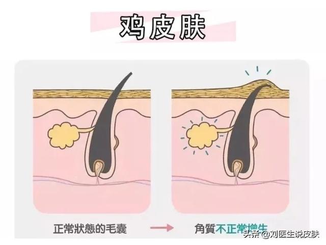 鸡皮皮肤怎么回事啊