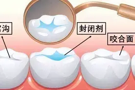 什么是窝沟封闭？孩子要做窝沟封闭吗？图片