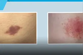 发现「吻痕」以为是出轨的证据，没想到是一种病图片