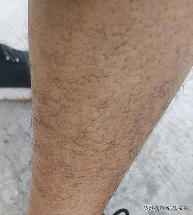 腿干燥鱼鳞一样怎么回事