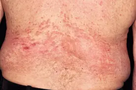 一个疏忽可能会让你“毁容”，14个皮肤上的小问题，你要小心了图片