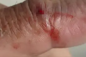 好危险！广西一男子被剧毒“肾亏蛇”咬伤！这是什么蛇？有多毒？图片