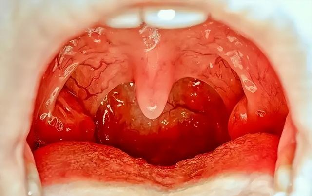 小石头学五官之慢性扁桃体炎