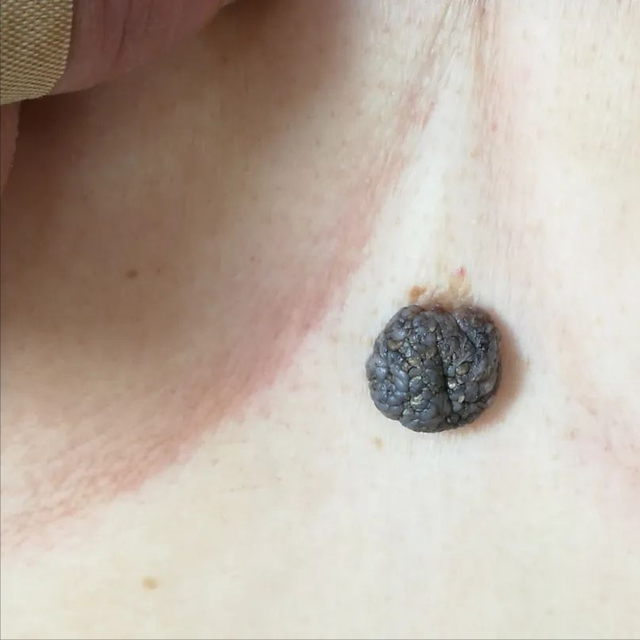 角化棘皮瘤的病理要点