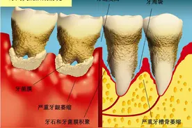 种植专家：不可盲目种牙，这些人不建议种牙图片