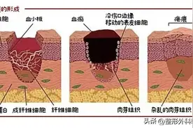 修复疤痕有这些方法，你知道吗？图片